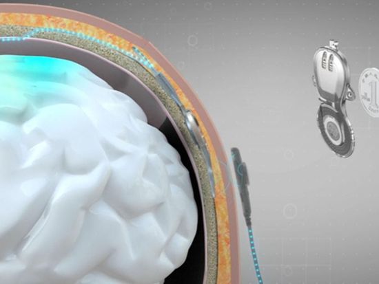 China leads the world in invasive BCI products