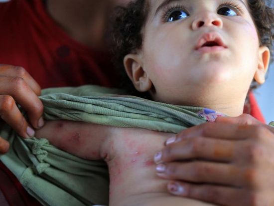 UNRWA reports over 125,000 skin infections in Gaza during Jan-May