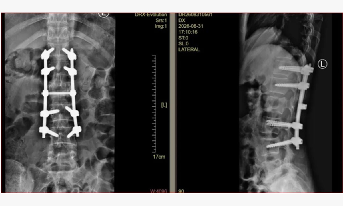 Postoperative digital X-ray image of Patient 2. Photo: Shenzhen Pingshan Hospital of Southern Medical University